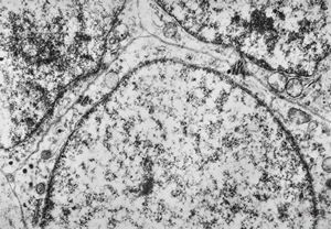 M,5y. | retroperitoneal neuroblastoma - metastasis to neck M,5y. | retroperitoneal neuroblastoma - metastasis to neck